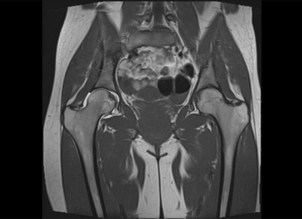 Trocanterită a simptomelor articulare de șold, tratament, prognostic și fotografie pr
