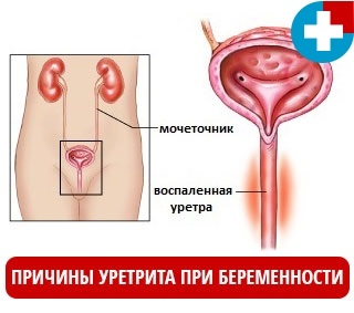 Explicaţia tratamentului uretritei la bărbaţi şi la femei | sanatateeuropeana.ro