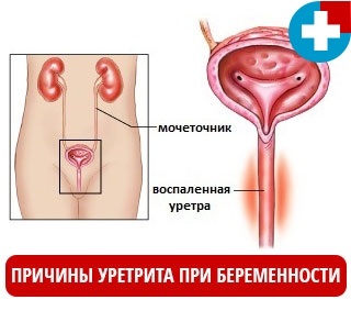 Uretrita în timpul sarcinii - tratament și simptome