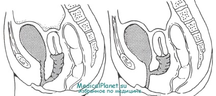 Sinuzul urogenital - cauze, diagnostic