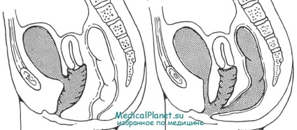 Sinuzul urogenital - cauze, diagnostic