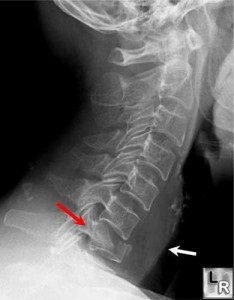 Îngrijirea pacienților cu leziuni ale coloanei vertebrale, măduvei spinării, pelvisului