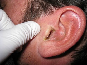 În interiorul nasului, protuberanțe semicirculare în interiorul cavității nazale - nu există nas curbat