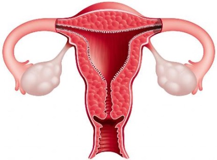 Inflamația uterului - cauze, simptome și tratament