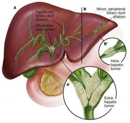 Informații generale despre cholangiocarcinom, etape de dezvoltare