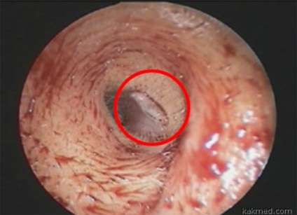 Viața cu viermi în urechea unei femei din Taiwan în canalul auditiv a găsit o larvă Drosophila