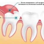 Înțelepciunea consecințelor îndepărtării dinților și posibilele complicații