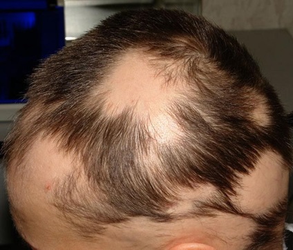 Alopecia la bărbați, focală, difuză, seboreică, principii de tratament