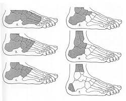 Caracteristicile anatomice ale picioarelor de coapse și șoldului și ale protezelor acestora