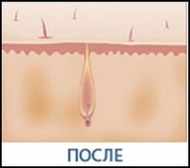 Tratamentul hardware al acneei