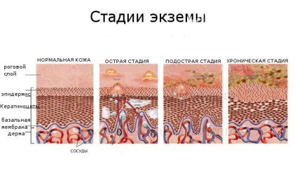 Чи беруть в армію з екземою, служба допомоги призовникам