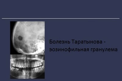 Boala lui Taratynova este un granulom eozinofilic, un jurnal cu articole medicale 