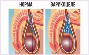 Durere în varicocelă, varicocelă și durere în testicul