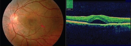 Chorioretinopatia centrală seroasă (tschrp) - decât periculoasă, motivele, simptomele și metodele de tratament pe