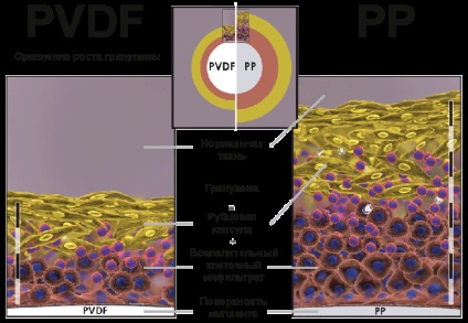 Grilă hernie, pvdf germanium