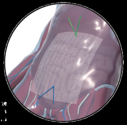 Grid hernia, pvdf germánium