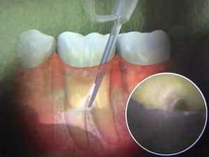 Care este chiuretajul închis și deschis al buzelor parodontale, procedura acestor operații, sfaturi