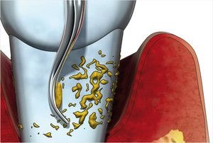 Mit jelent a periodontális zsebek zárt és nyitott curettageje, ezeknek a műveleteknek a folyamata, tippek