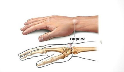 Mi a hygroma, a hygroma kép, mi a csuklócsukló higroma