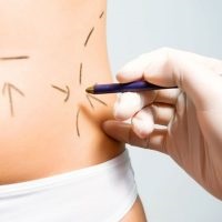 Ce este liposucția și cât de mult este necesar să faci liposucția abdomenului, a picioarelor și a întregului corp