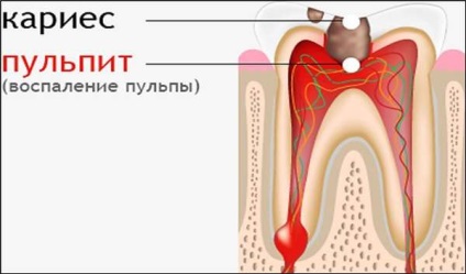 Ce este pulpita dintelui, simptomatologie, varietăți, diagnostic, tratament - video - 