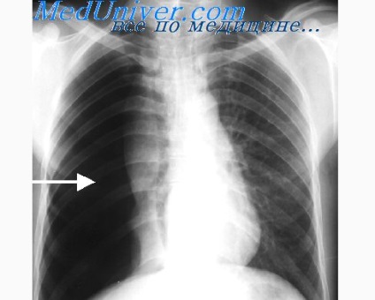 Cianoza in insuficienta cardiaca - tratament cardiac