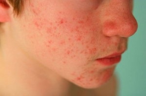 Dermatitis az arcán felnőtt fotók, okok és kezelés