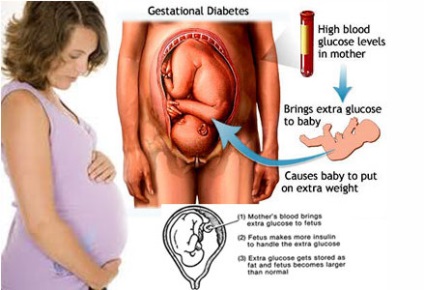 Diabetul de factori de risc gestațional, caracteristicile tratamentului și efectele asupra dezvoltării fetale