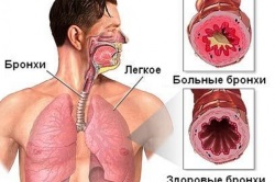 Diétás bronchitis