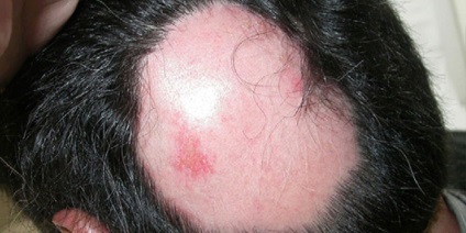 Alopecia difuză la femei și bărbați cauzează și tratamentul căderii părului