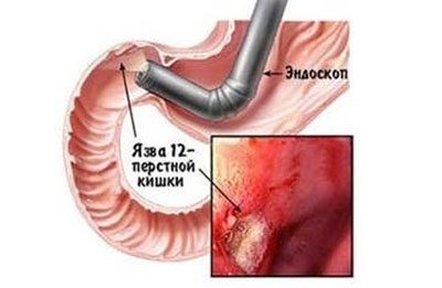 Drotaverina si alcoolul va ajuta daca nu-shpa cu mahmureala