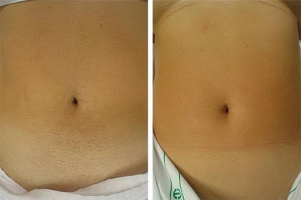 Fotoepilarea abdomenului la femei în Moscova - recenzii, fotografii, videoclipuri, prețuri
