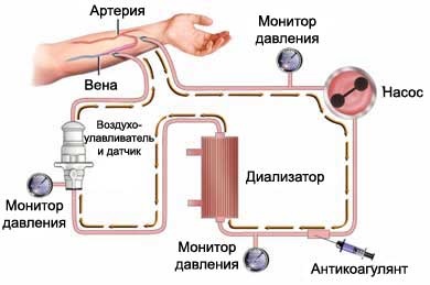 Hemodializa descrierii rinichilor si esenta procedurii