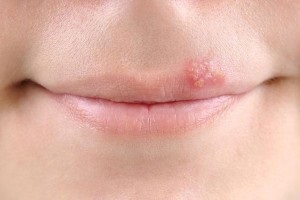 Herpes inkubációs időszak nőkben