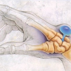 Hygroma Tratamentul încheieturii mâinii