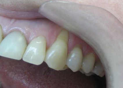 Granulomul din tratamentul rădăcinii dentare a granuloamelor pe rădăcina dintelui, simptome de granulom pe rădăcina dintelui