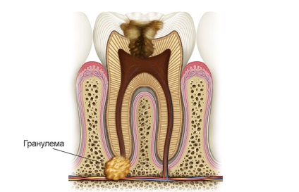 Granulom pe rădăcina simptomelor dintelui 5 și 3 metode de tratament