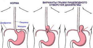 Herniasis al simptomelor esofagului și tratamentul remediilor populare, alimentației