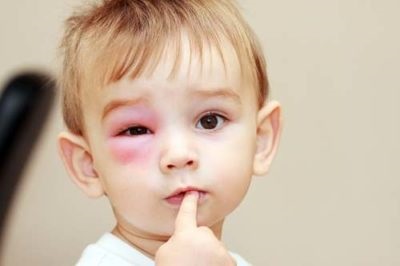 Cum să tratați orzul pe ochii unui copil așa cum arată și dacă este posibil să mergeți la o grădiniță sau la o școală
