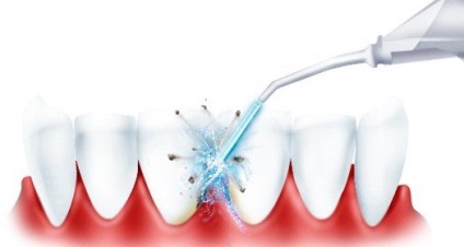 Cum se utilizează un irigator pentru cavitatea bucală