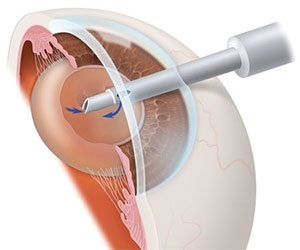 Cataracta chirurgie - de ce ai nevoie de ea