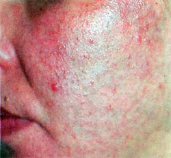 Clinica de cosmetologie medicală - acnee vital-roz (rozacee)
