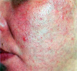 Orvosi kozmetológiai klinika - élethű rózsaszín akne (rosacea)