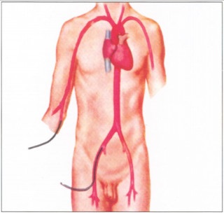 Angiografia coronariană și toate acestea