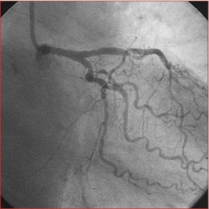 Angiografia coronariană și toate acestea