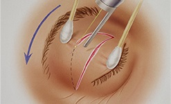 Blefaroplastia laser a pleoapelor și întinerirea ochilor - preț, recenzii, fotografii înainte și după