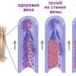 Tratamentul aterosclerozei, revizuirea diferitelor tratamente