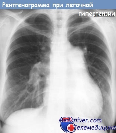 Cianoza pulmonară