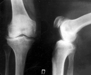 Rezultatul letal după cascada de artroplastie a genunchiului - n