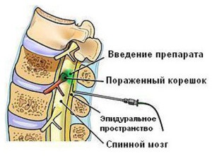 Az ágyéki, mellkasi, nyaki osztódások osteochondrosisának gyógykezelése